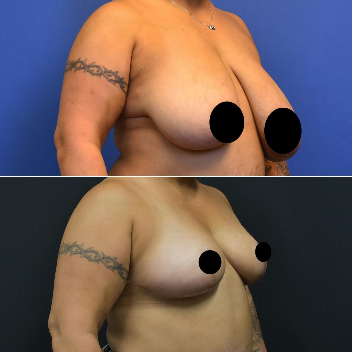 Breast Reduction Before & After Gallery - Patient 132274 - Image 2
