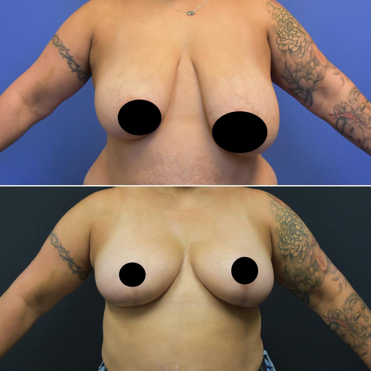 Breast Reduction Before & After Gallery - Patient 132274 - Image 1