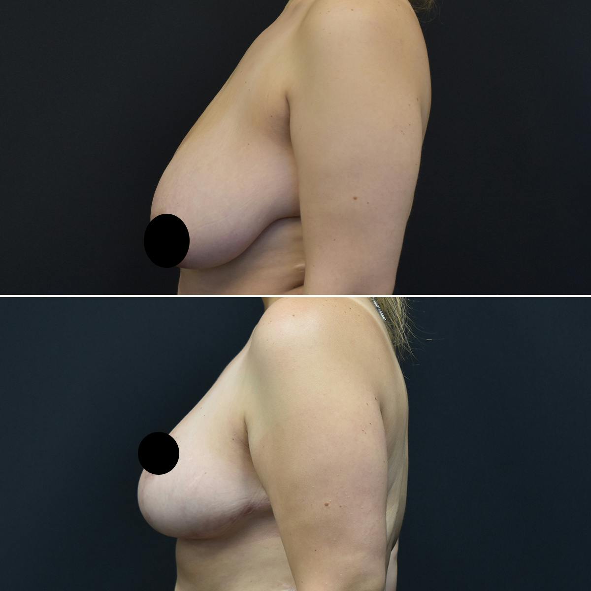 Breast Reduction Before & After Gallery - Patient 396141 - Image 2