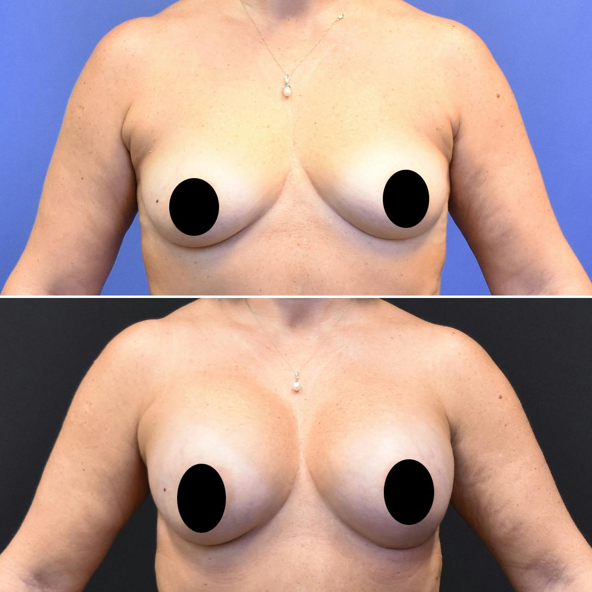 Breast Augmentation Before & After Gallery - Patient 121579 - Image 1