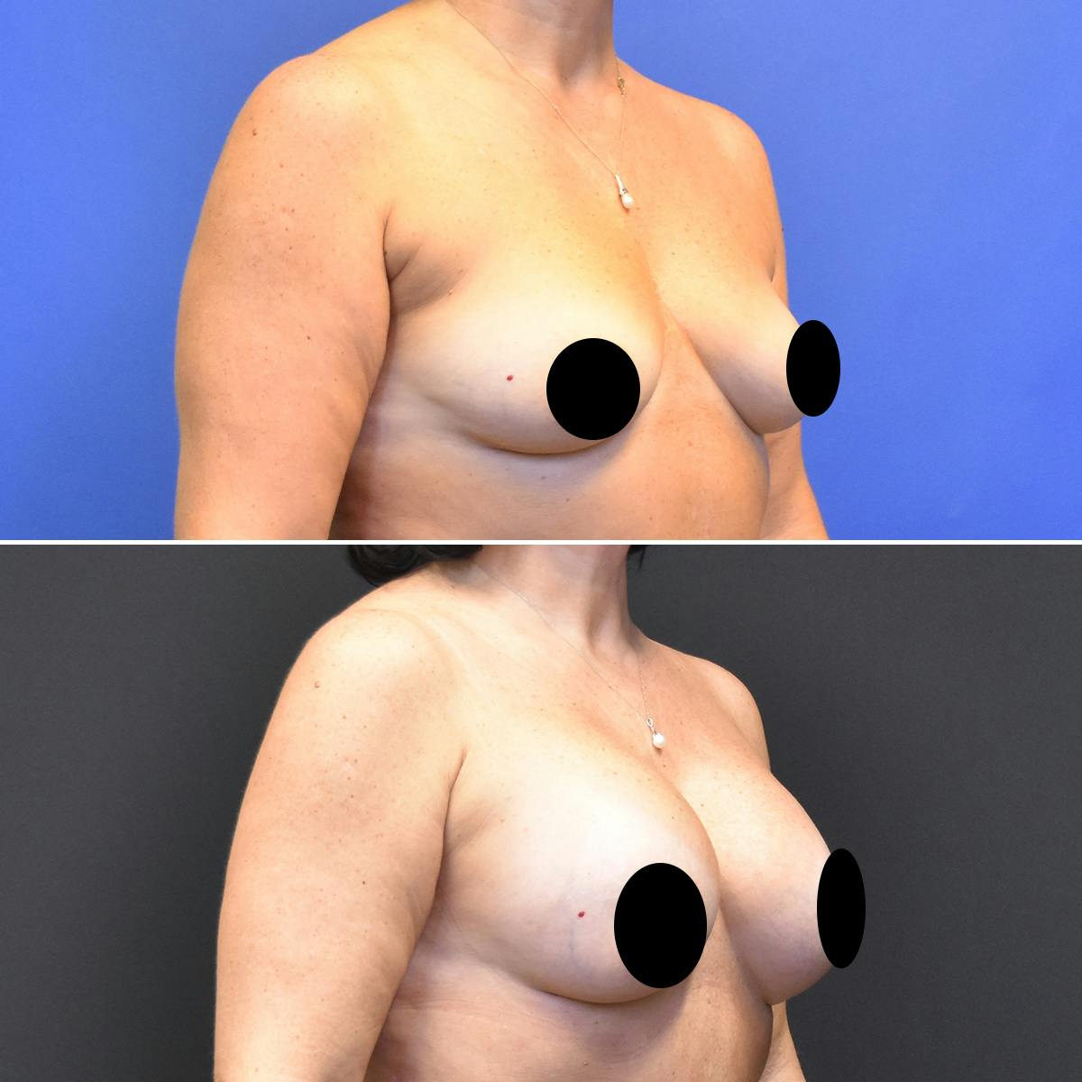 Breast Augmentation Before & After Gallery - Patient 121579 - Image 2