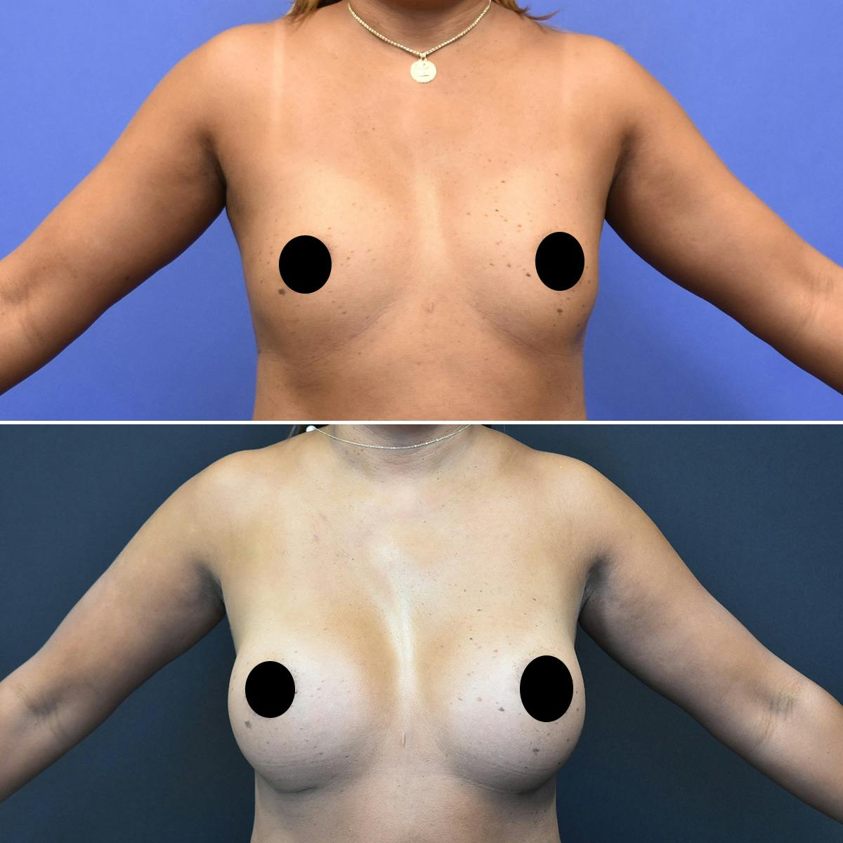Breast Augmentation Before & After Gallery - Patient 403650 - Image 1