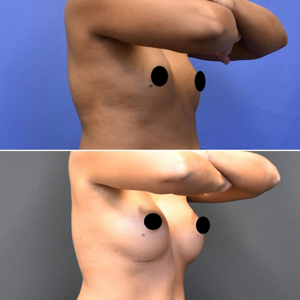 Breast Augmentation Before & After Gallery - Patient 403650 - Image 2