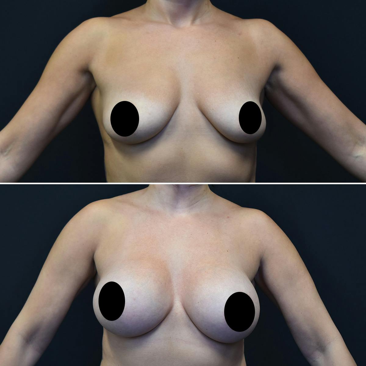 Breast Augmentation Before & After Gallery - Patient 235075 - Image 1