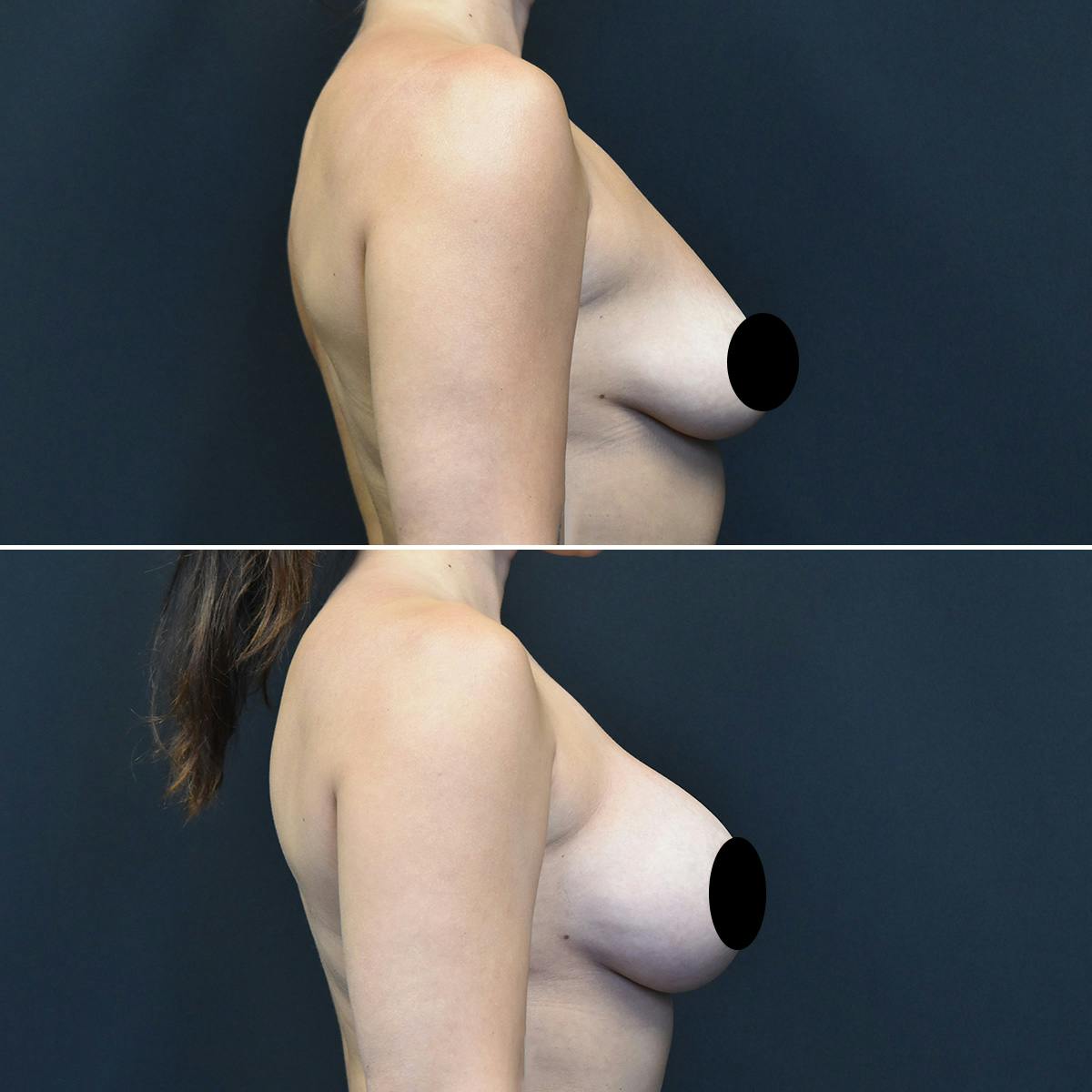 Breast Augmentation Before & After Gallery - Patient 235075 - Image 3