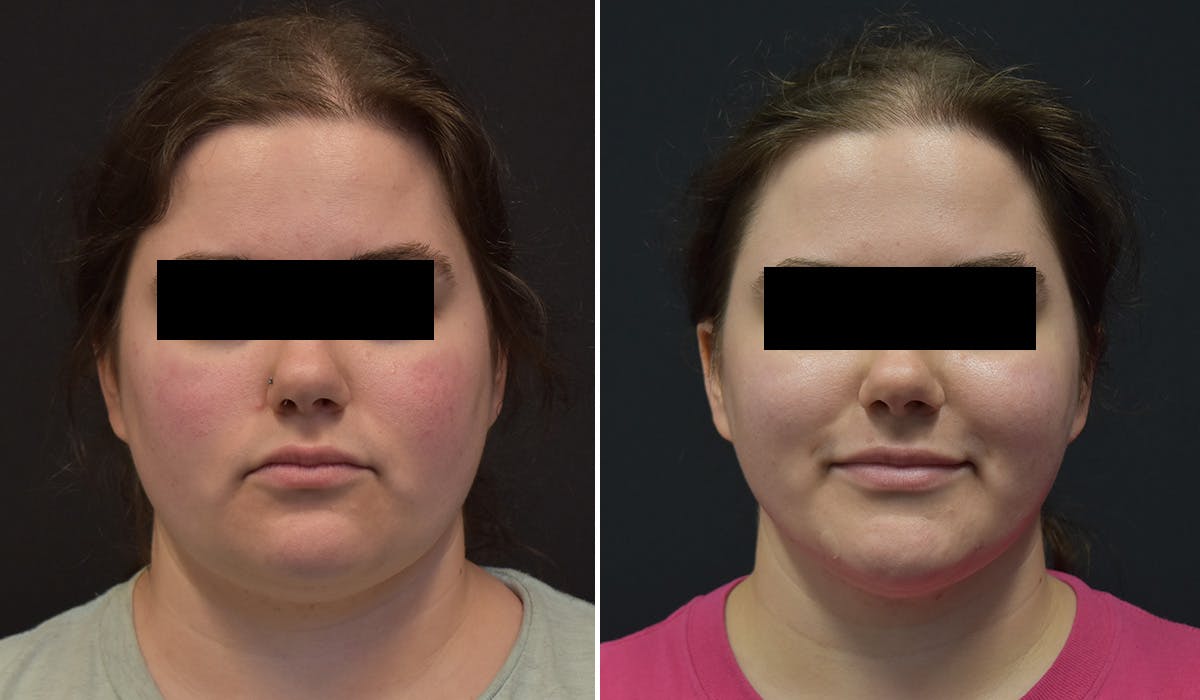 FaceTite Before & After Gallery - Patient 148982 - Image 1