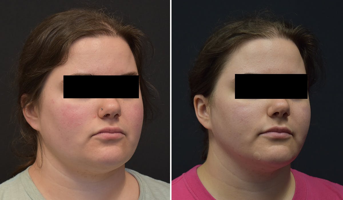 FaceTite Before & After Gallery - Patient 148982 - Image 2