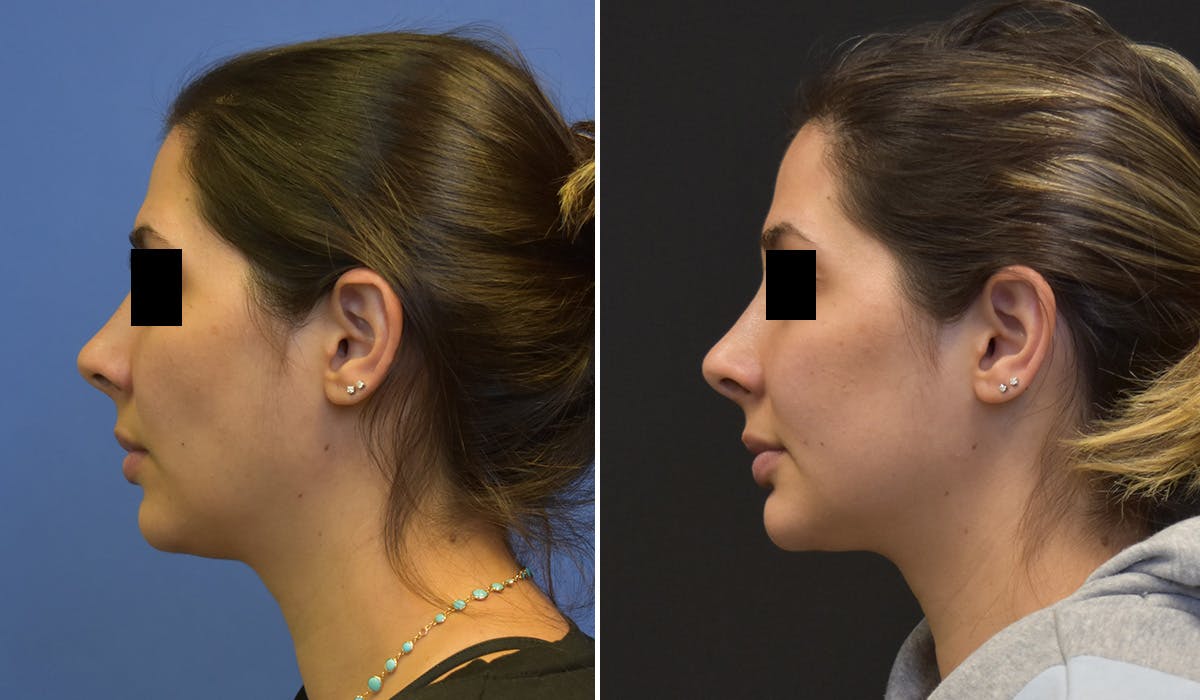 FaceTite Before & After Gallery - Patient 260837 - Image 2