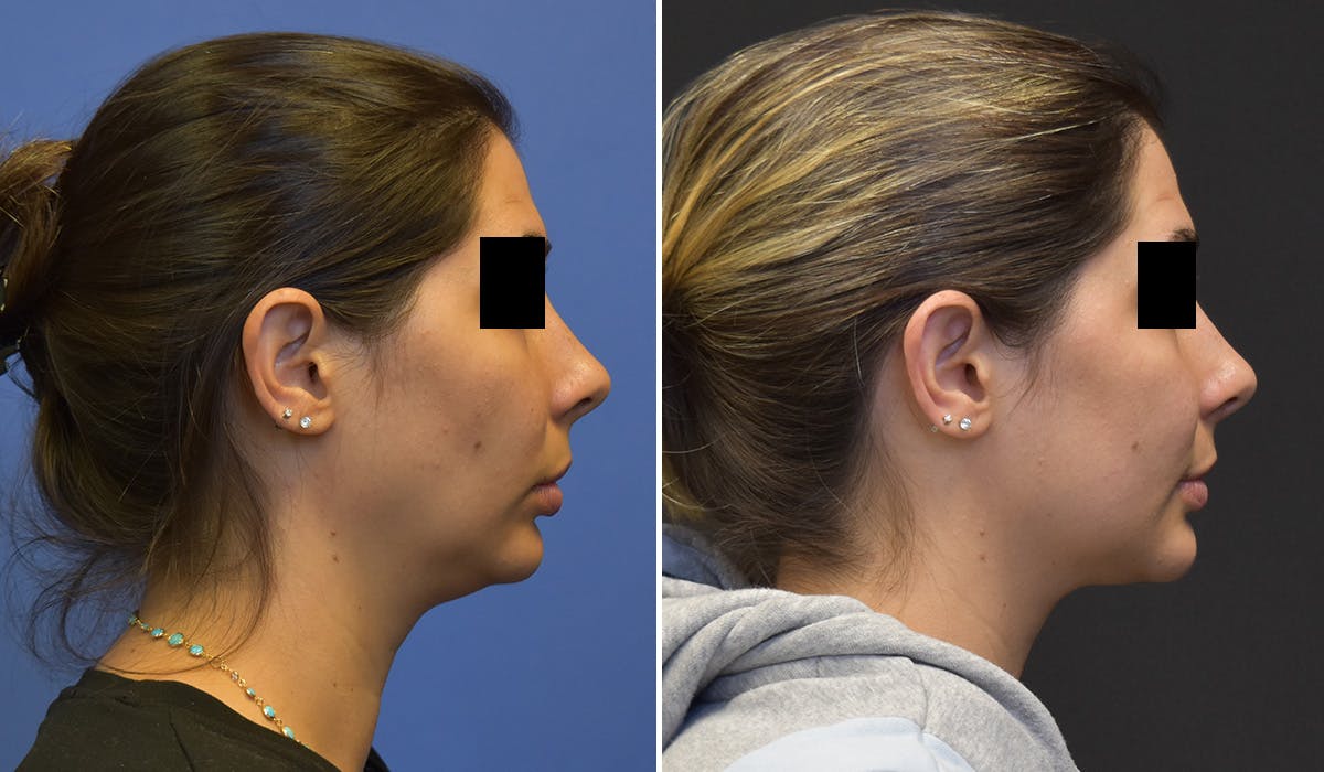 FaceTite Before & After Gallery - Patient 260837 - Image 1