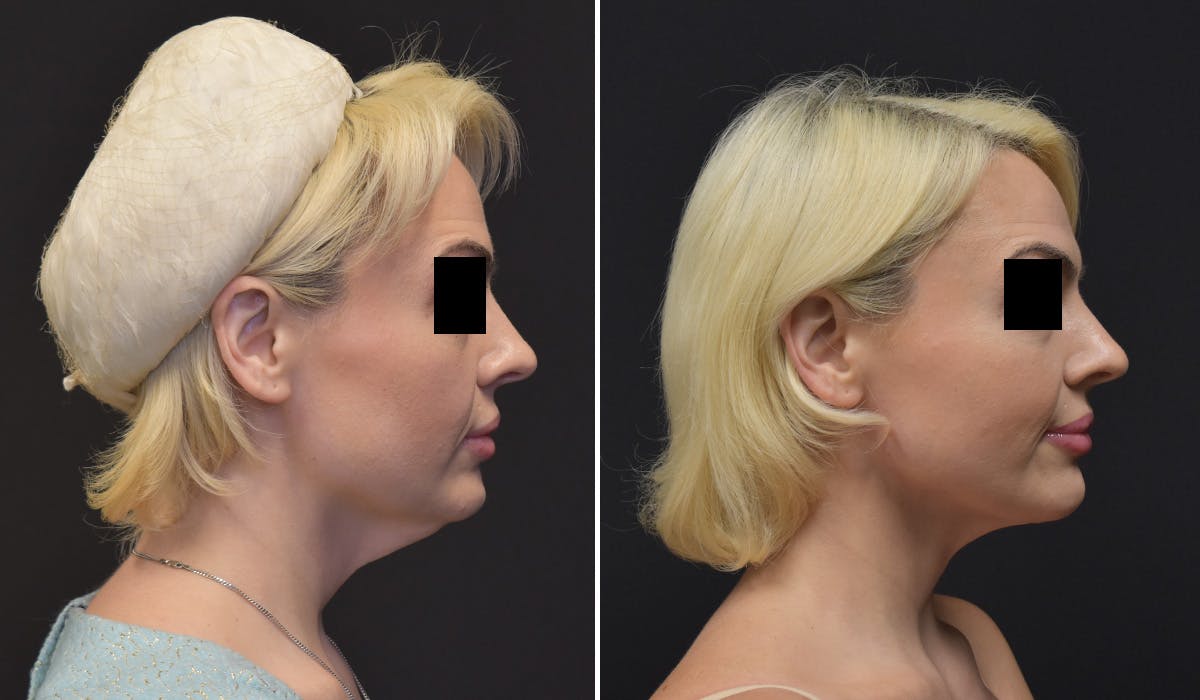 Neck Lift Before & After Gallery - Patient 266841 - Image 2