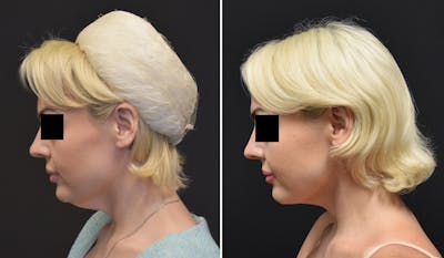 Neck Lift Before & After Gallery - Patient 266841 - Image 1