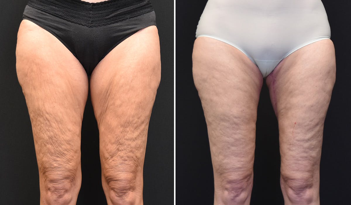 Thigh Lift Before & After Gallery - Patient 197980 - Image 1