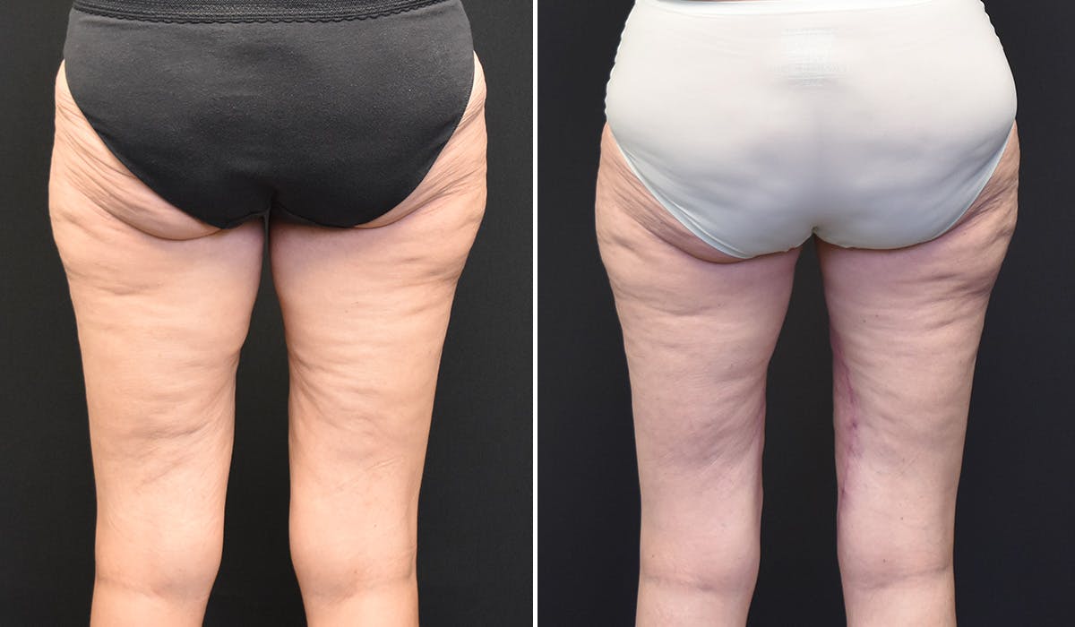 Thigh Lift Before & After Gallery - Patient 197980 - Image 2