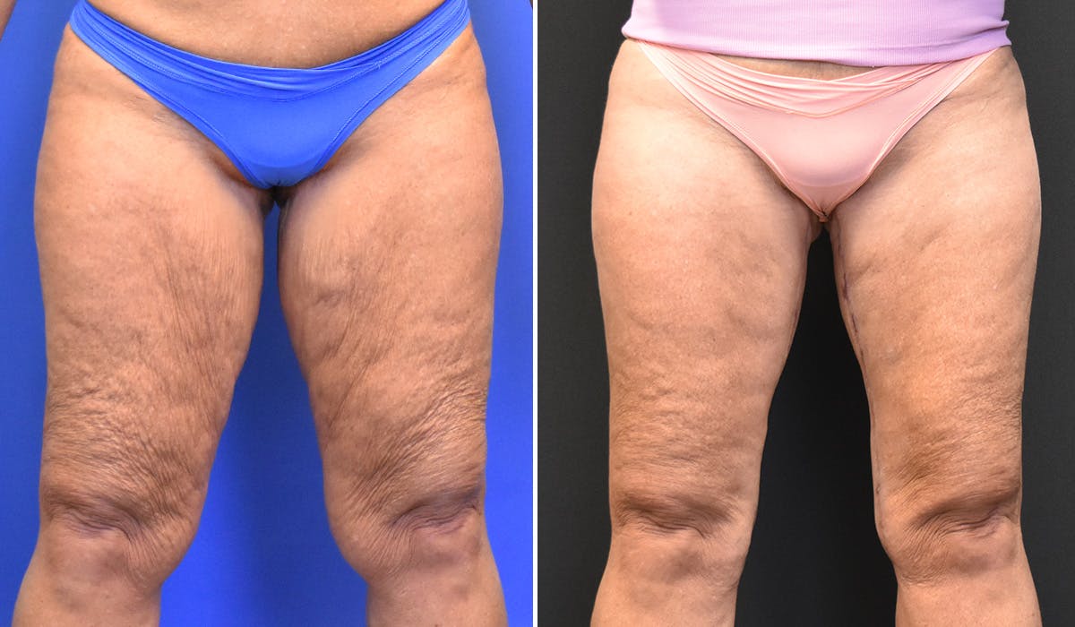 Thigh Lift Before & After Gallery - Patient 181904 - Image 1