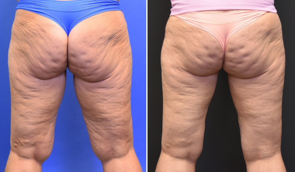 Thigh Lift Before & After Gallery - Patient 181904 - Image 2