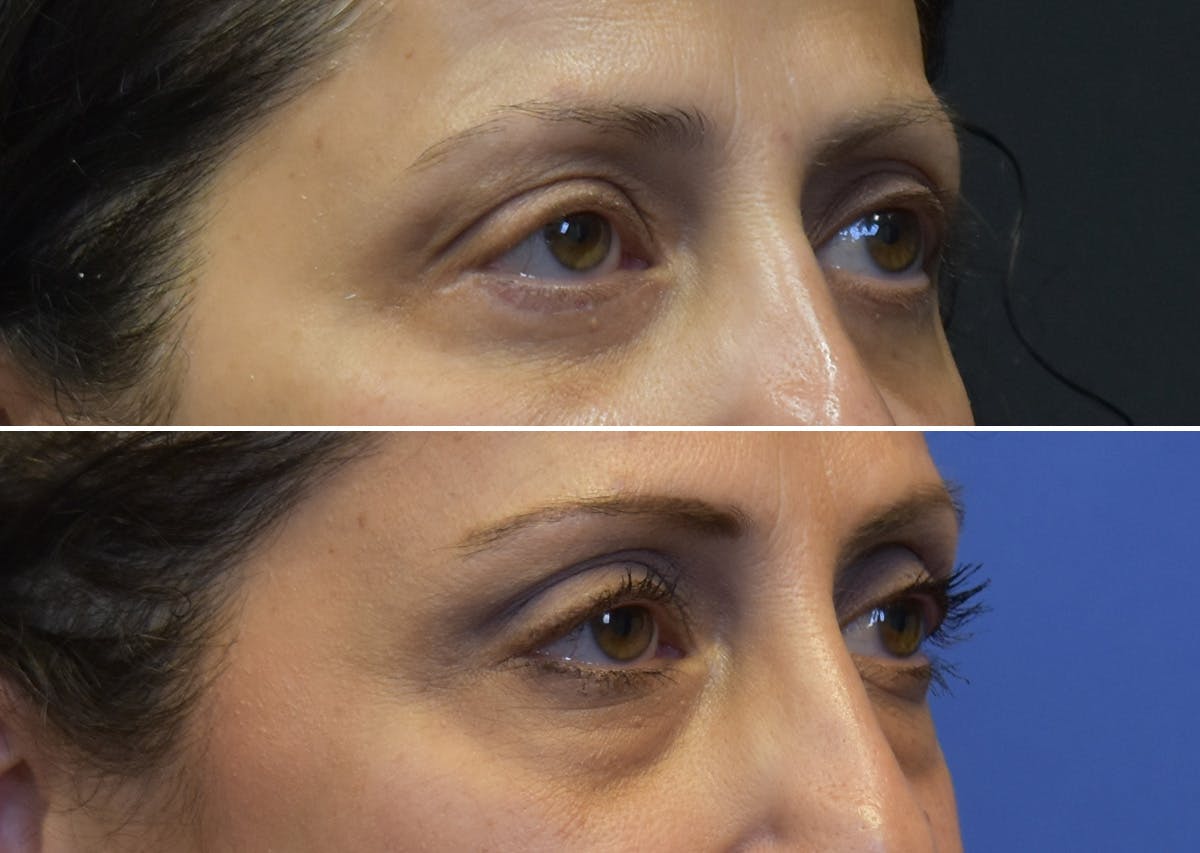 Blepharoplasty (Eyelid Surgery) Before & After Gallery - Patient 397408 - Image 2
