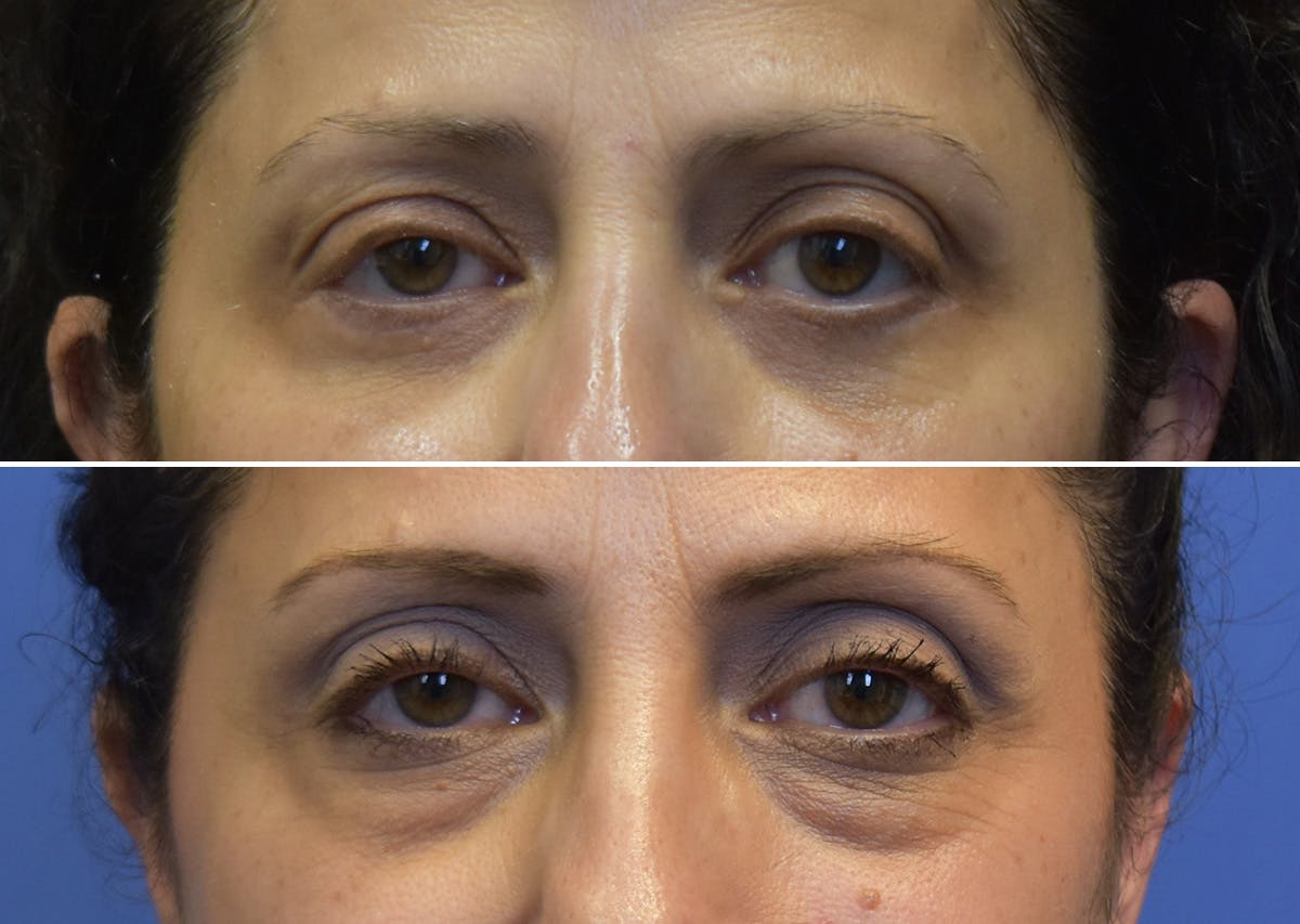 Blepharoplasty (Eyelid Surgery) Before & After Gallery - Patient 397408 - Image 1