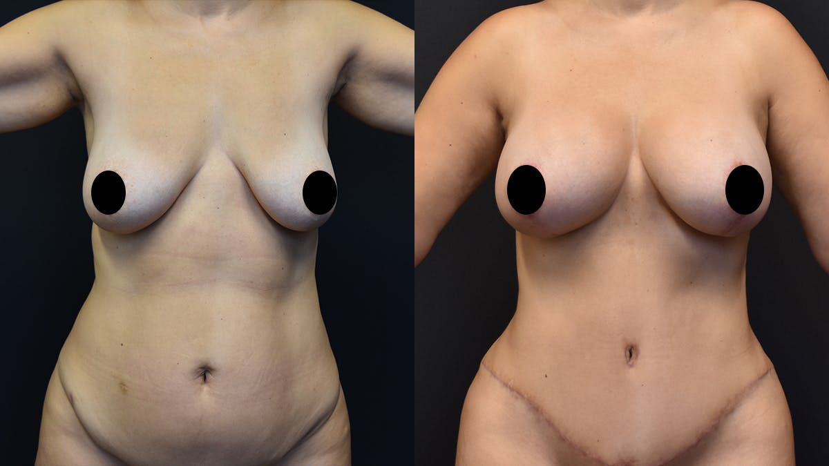 Mommy Makeover Before & After Gallery - Patient 420154 - Image 1