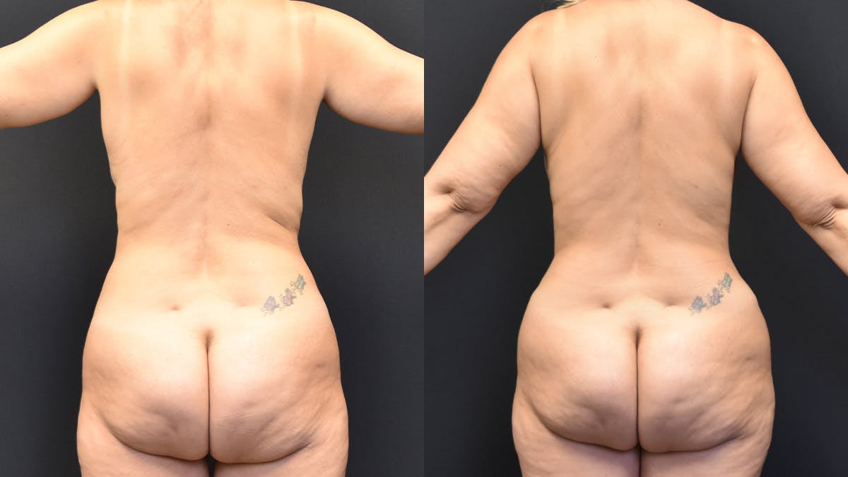 Mommy Makeover Before & After Gallery - Patient 420154 - Image 3