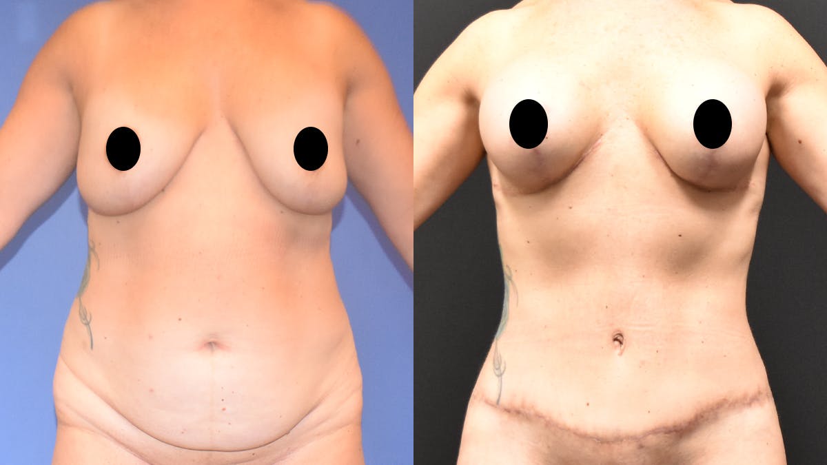 Mommy Makeover Before & After Gallery - Patient 233753 - Image 1