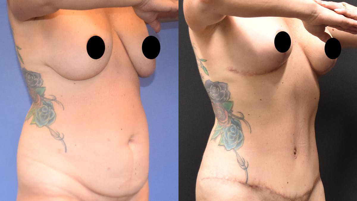 Mommy Makeover Before & After Gallery - Patient 233753 - Image 2
