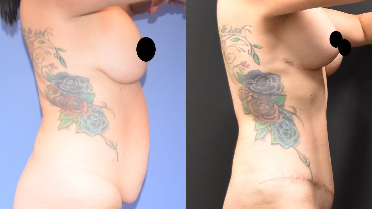 Mommy Makeover Before & After Gallery - Patient 233753 - Image 3