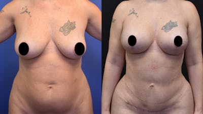 Mommy Makeover Before & After Gallery - Patient 195413 - Image 1