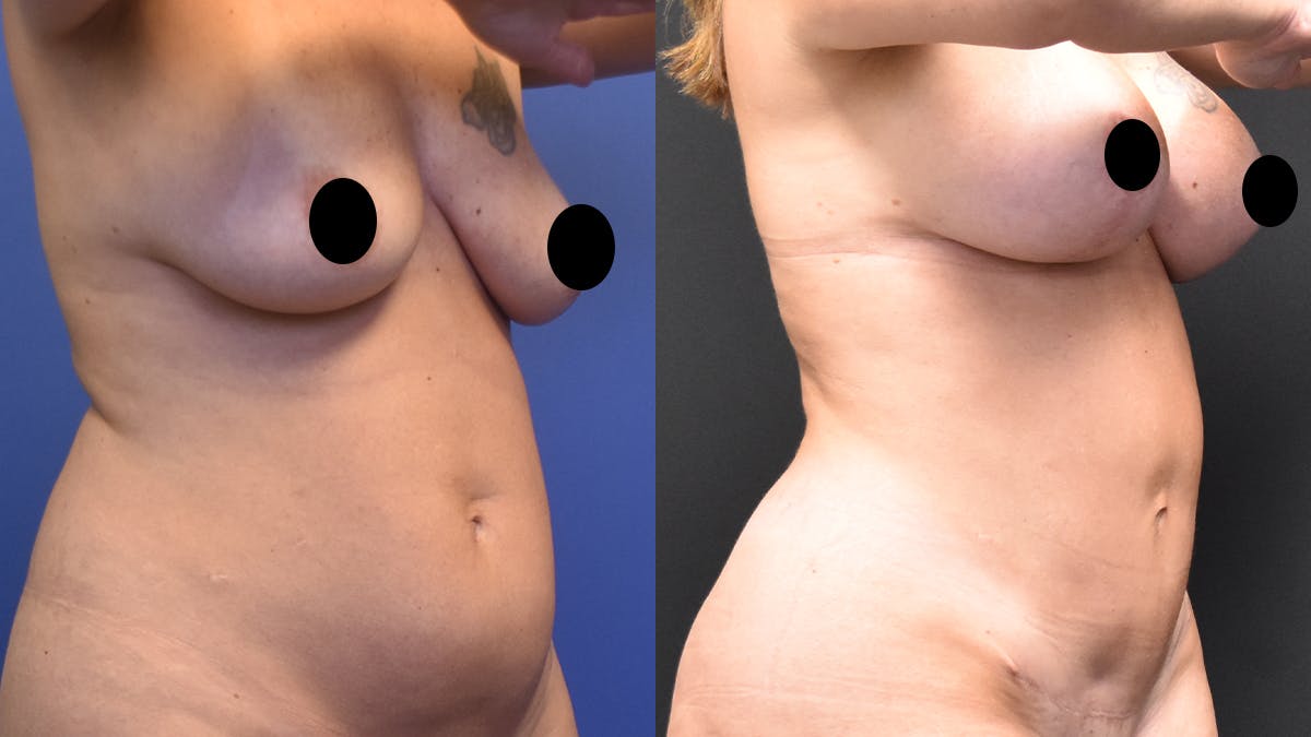 Mommy Makeover Before & After Gallery - Patient 195413 - Image 2