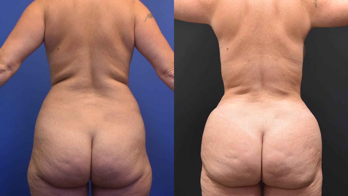Mommy Makeover Before & After Gallery - Patient 195413 - Image 3