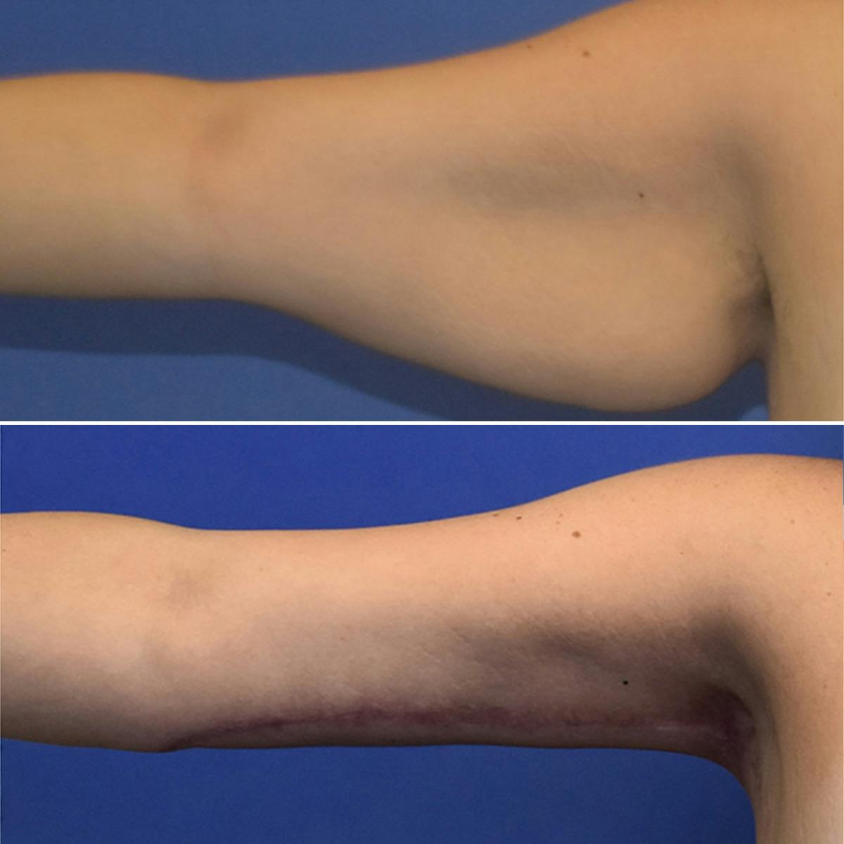 Arm Lift Before & After Gallery - Patient 846993 - Image 2