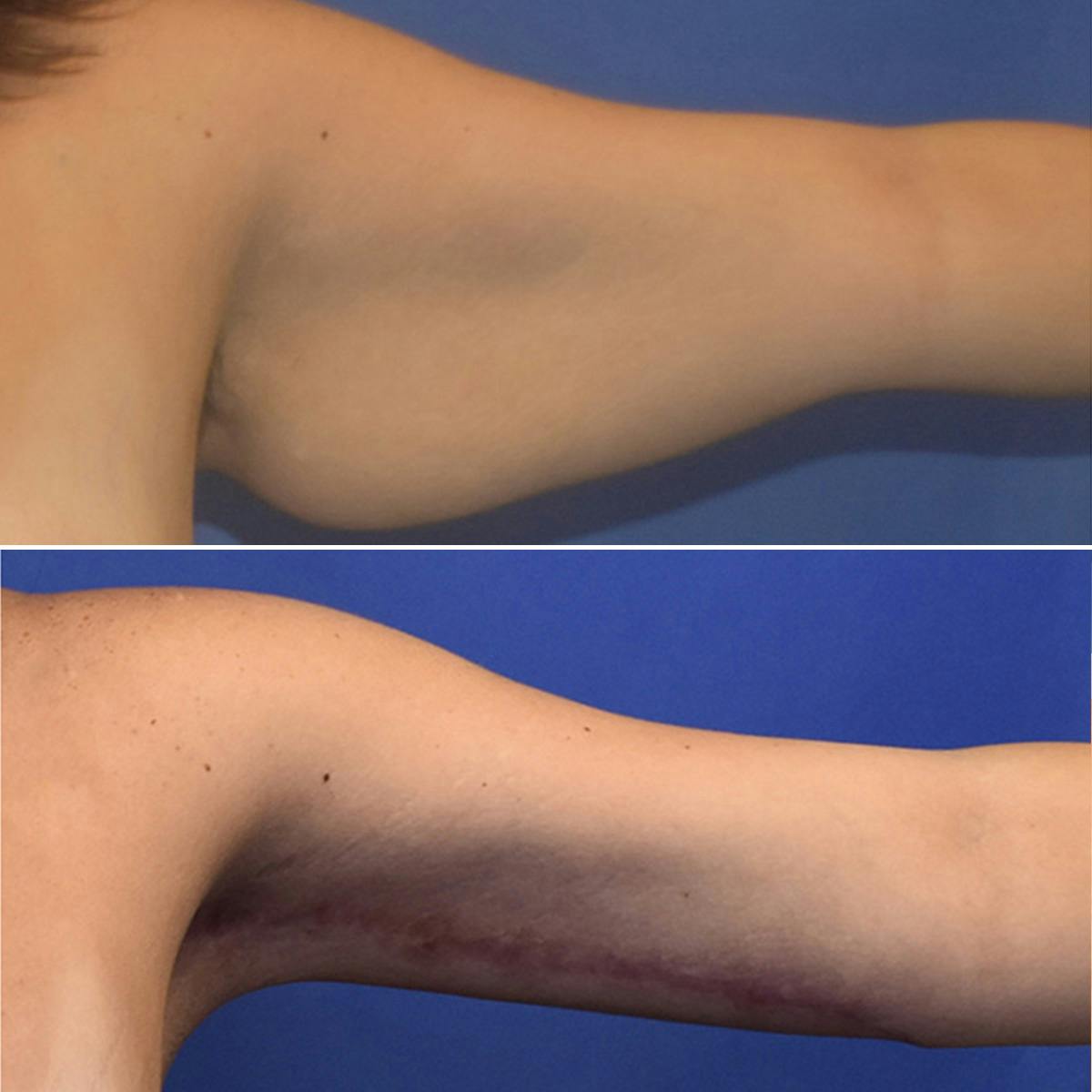 Arm Lift Before & After Gallery - Patient 846993 - Image 1