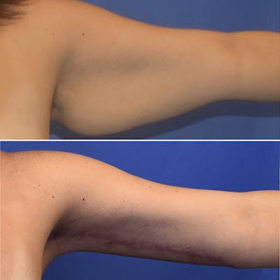 Arm Lift Before & After Gallery - Patient 846993 - Image 1
