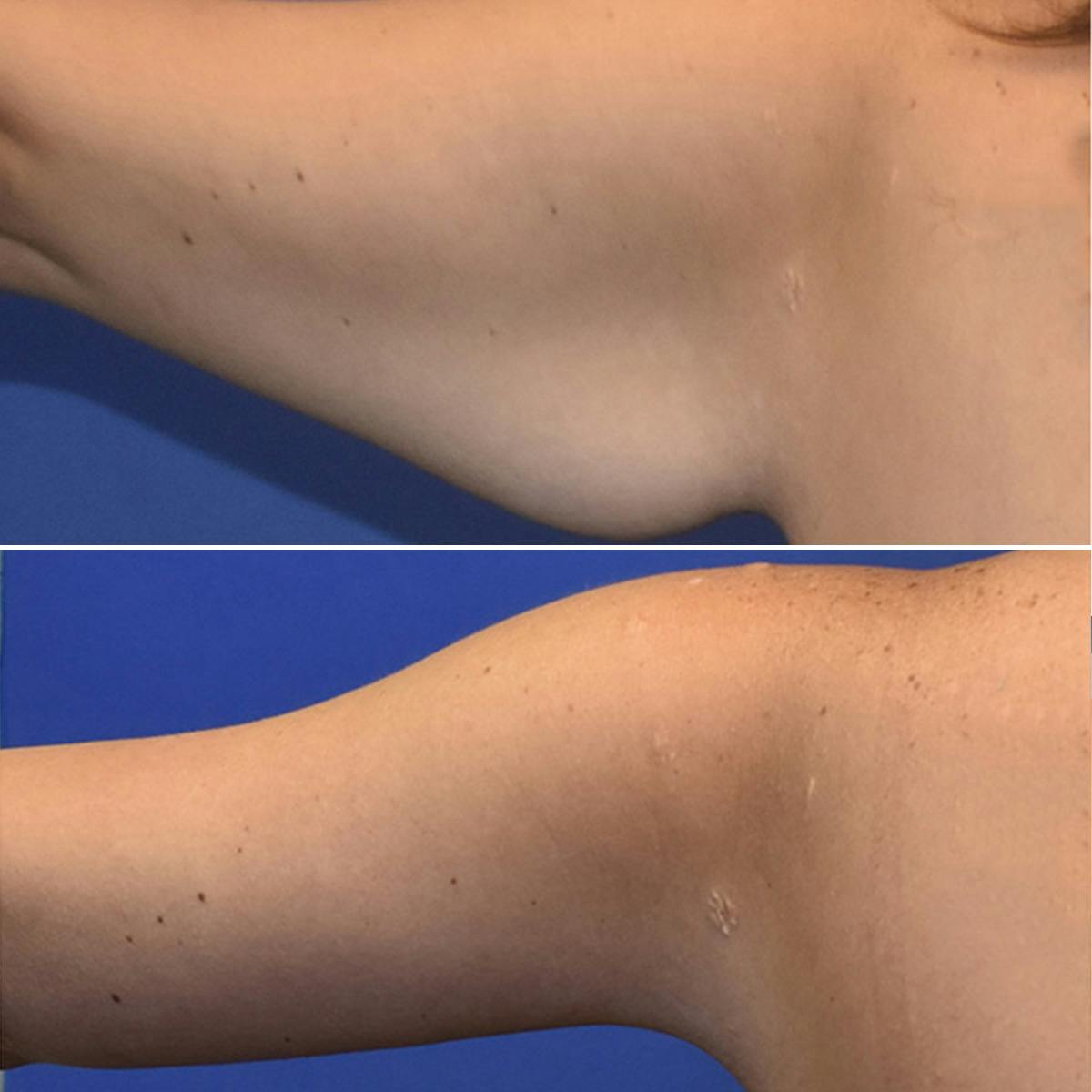 Arm Lift Before & After Gallery - Patient 846993 - Image 4