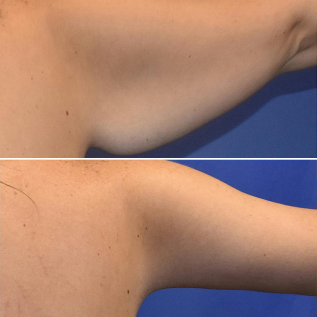 Arm Lift Before & After Gallery - Patient 846993 - Image 3