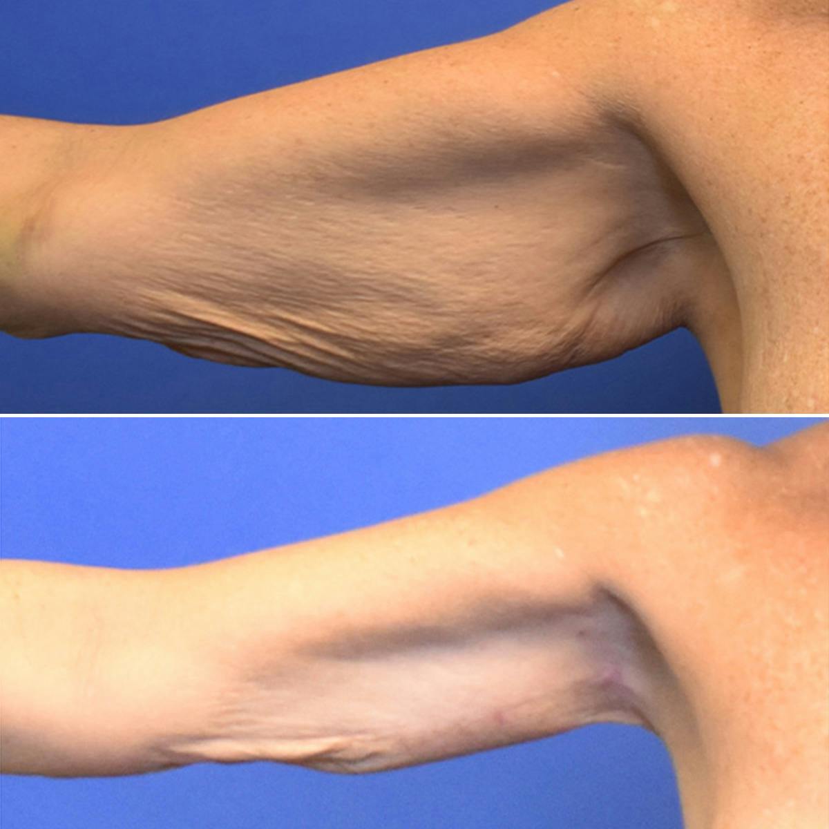 Arm Lift Before & After Gallery - Patient 222386 - Image 3