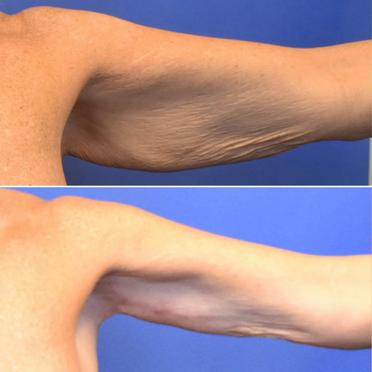 Arm Lift Before & After Gallery - Patient 222386 - Image 1