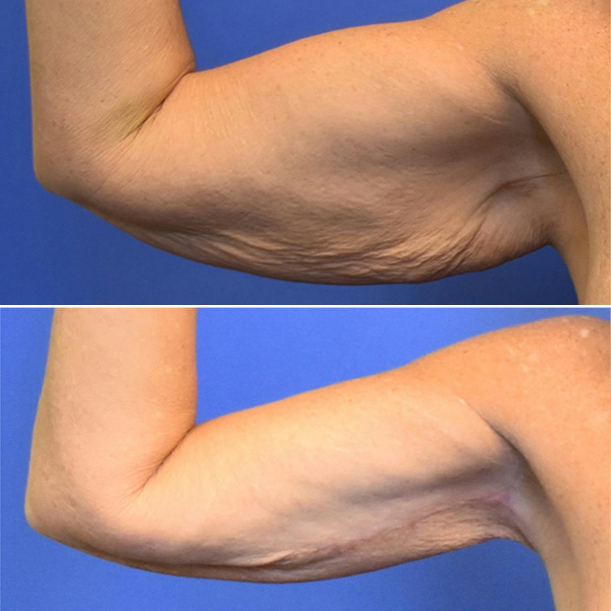 Arm Lift Before & After Gallery - Patient 222386 - Image 4