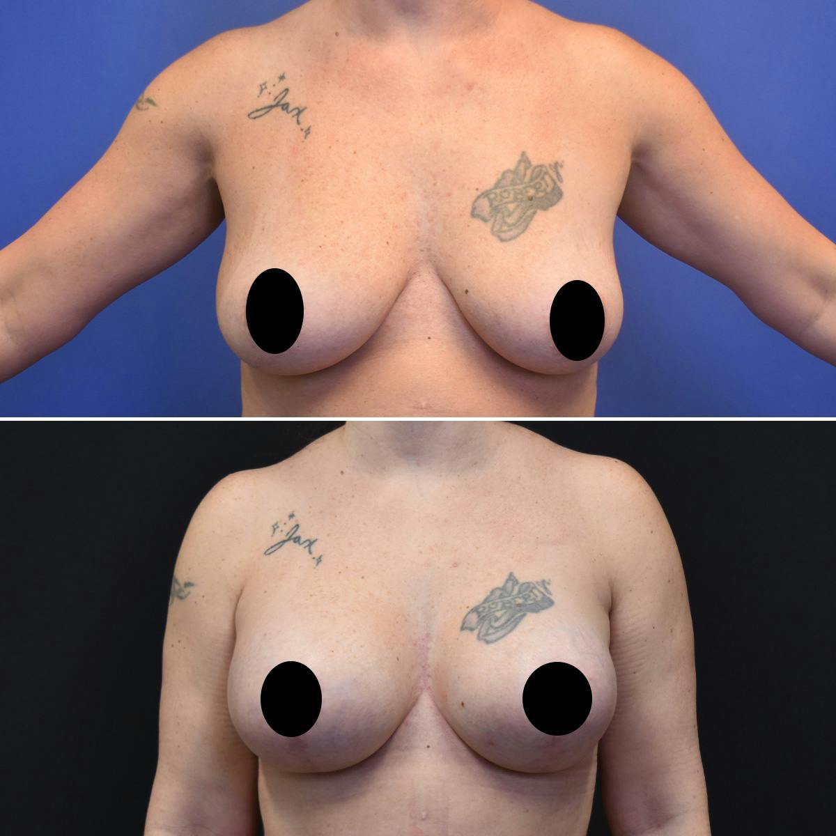 Breast Lift Before & After Gallery - Patient 342501 - Image 1