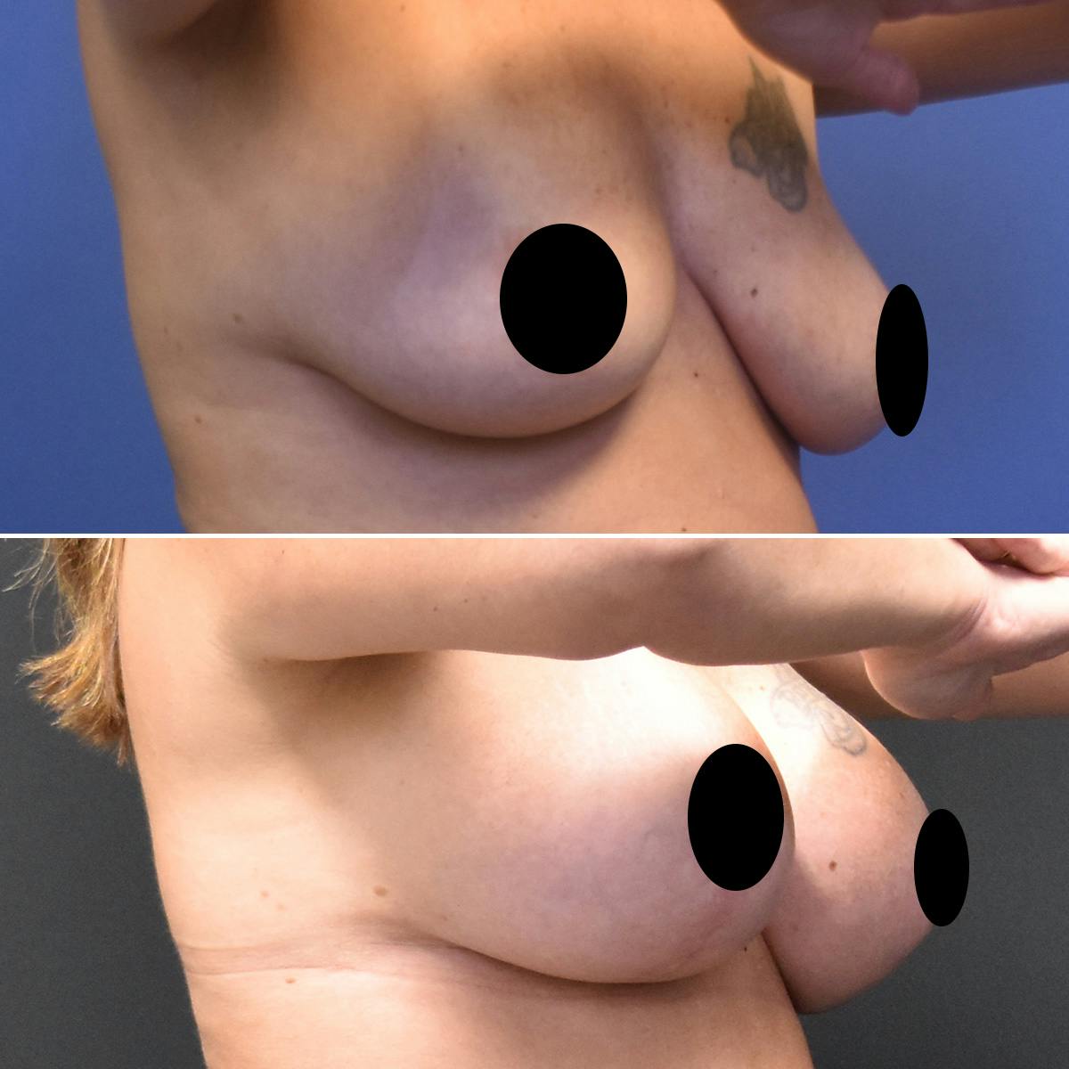 Breast Lift Before & After Gallery - Patient 342501 - Image 2