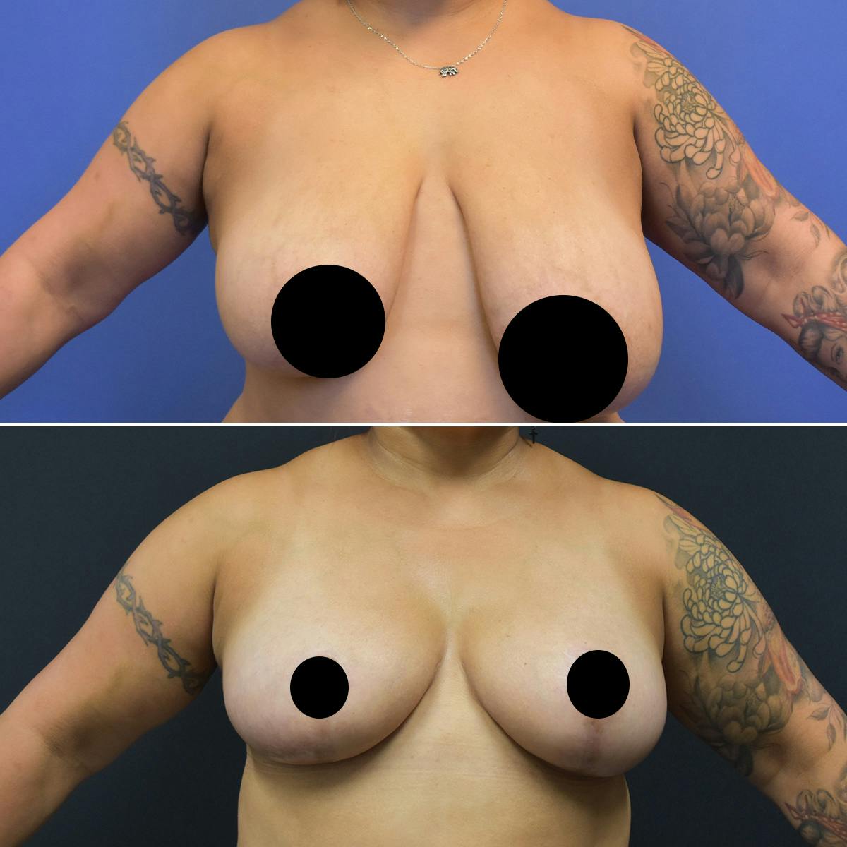 Breast Lift Before & After Gallery - Patient 849707 - Image 1
