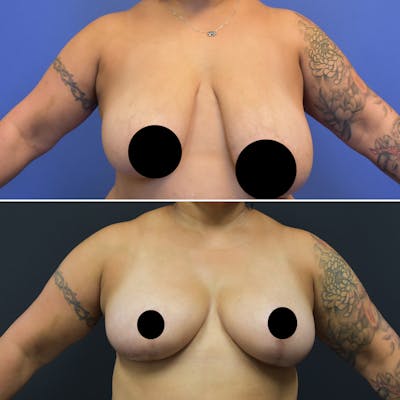 Breast Lift Before & After Gallery - Patient 849707 - Image 1