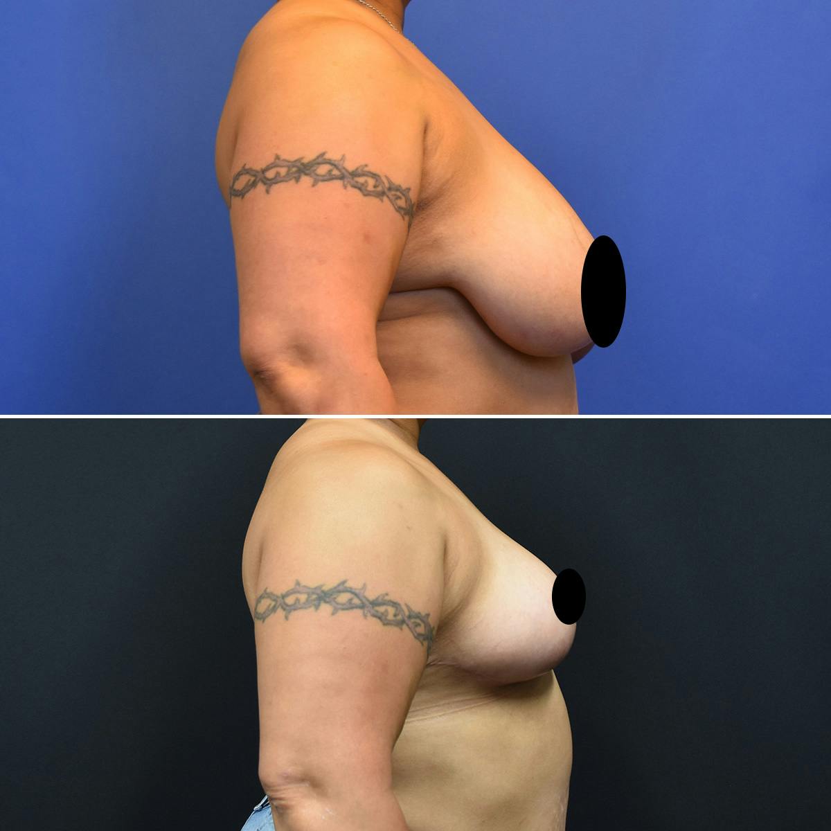 Breast Lift Before & After Gallery - Patient 849707 - Image 3