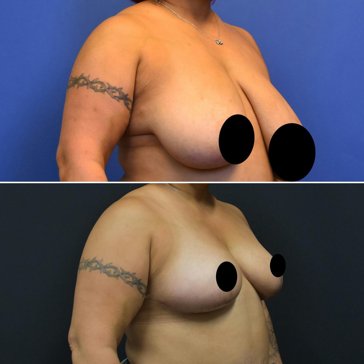 Breast Lift Before & After Gallery - Patient 849707 - Image 2