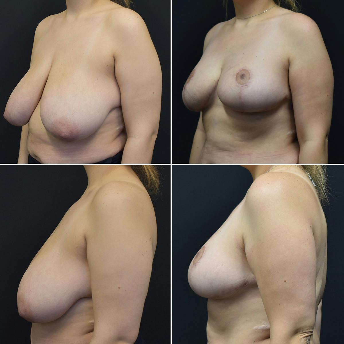 Liposuction Before & After Gallery - Patient 455350 - Image 1