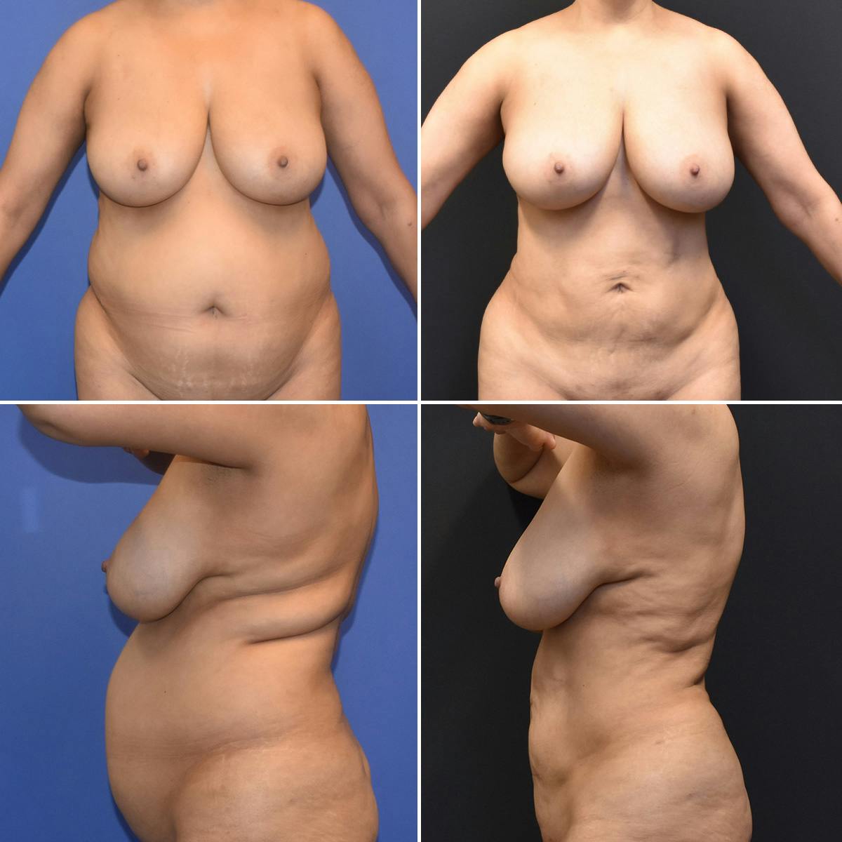 Liposuction Before & After Gallery - Patient 200728 - Image 1