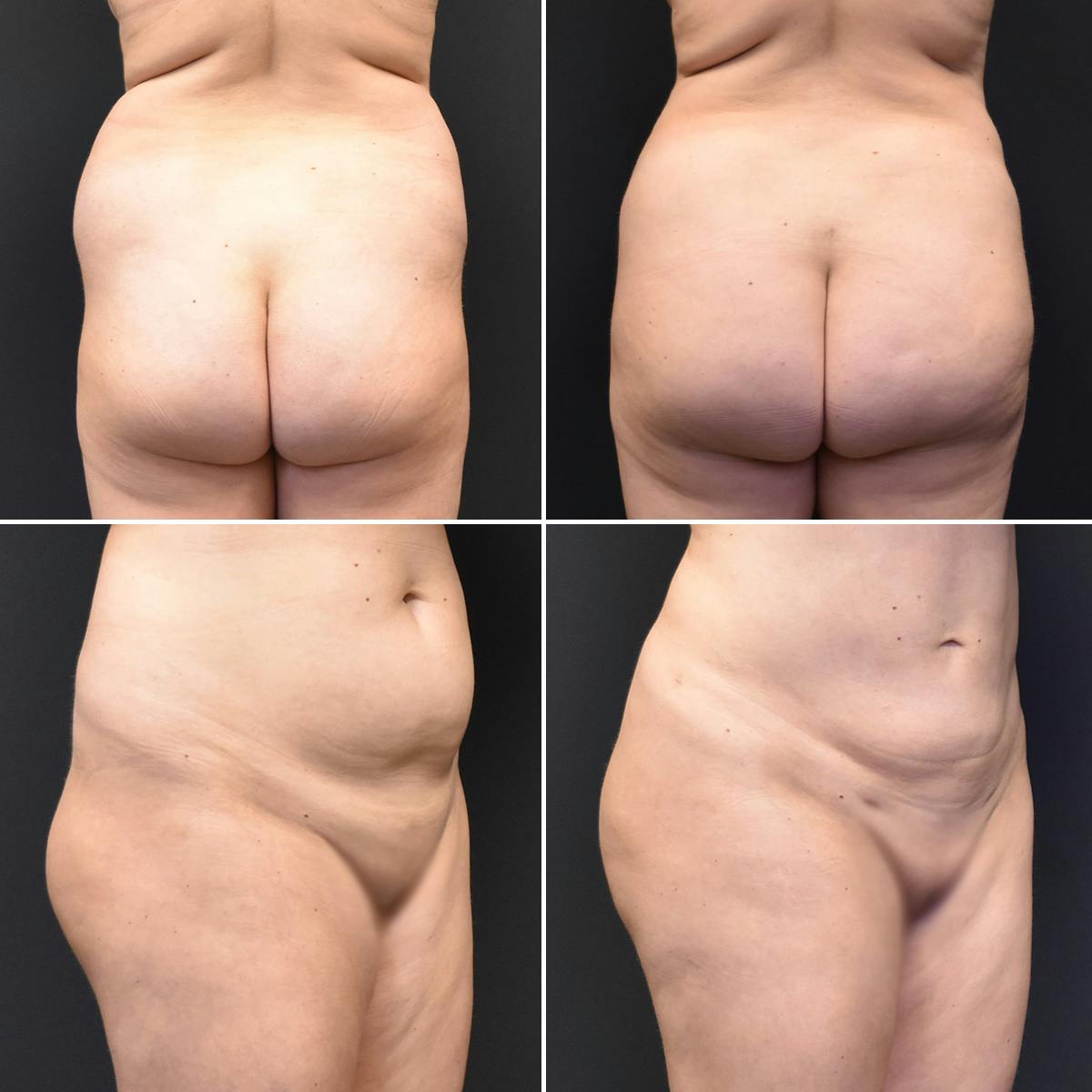 Liposuction Before & After Gallery - Patient 400089 - Image 1
