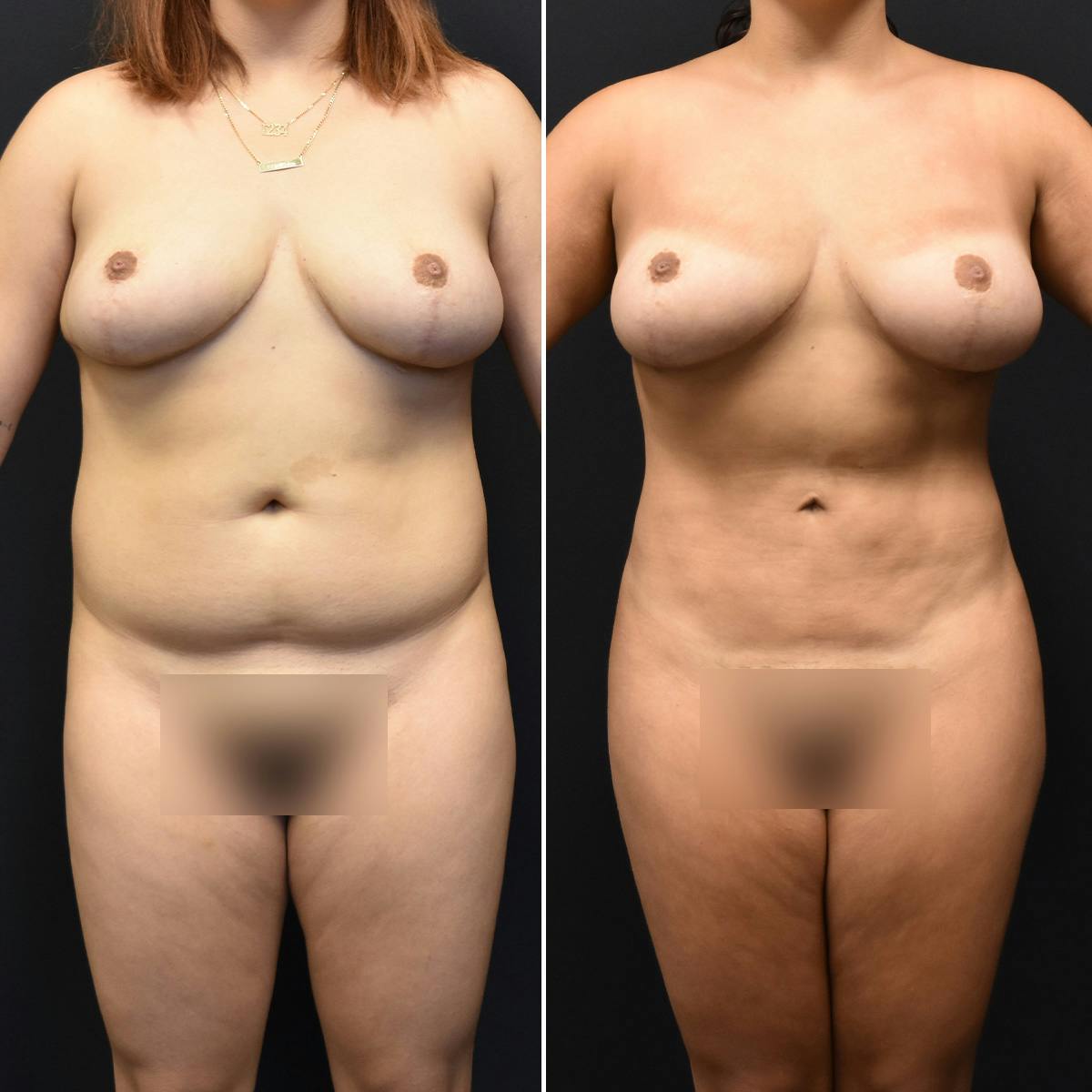 Liposuction Before & After Gallery - Patient 196452 - Image 1