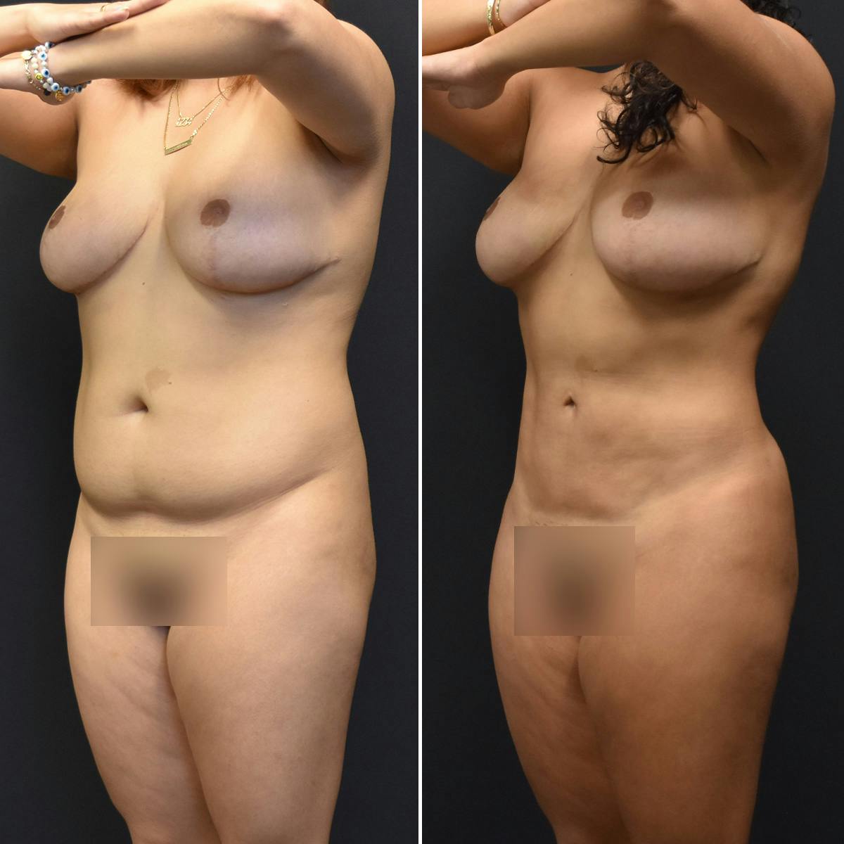 Liposuction Before & After Gallery - Patient 196452 - Image 2