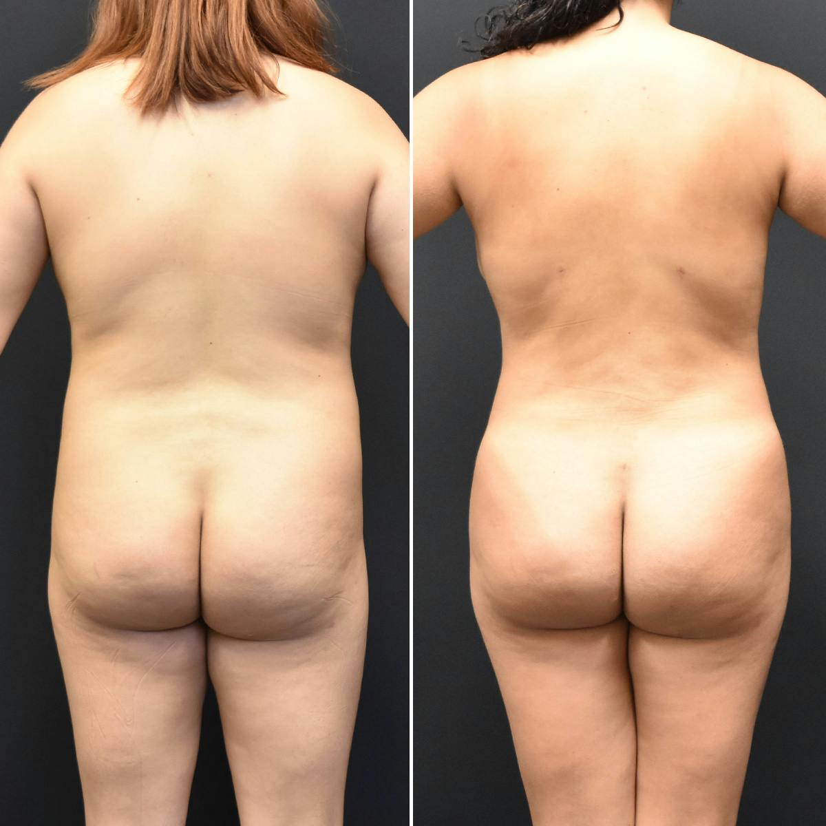 Liposuction Before & After Gallery - Patient 196452 - Image 3