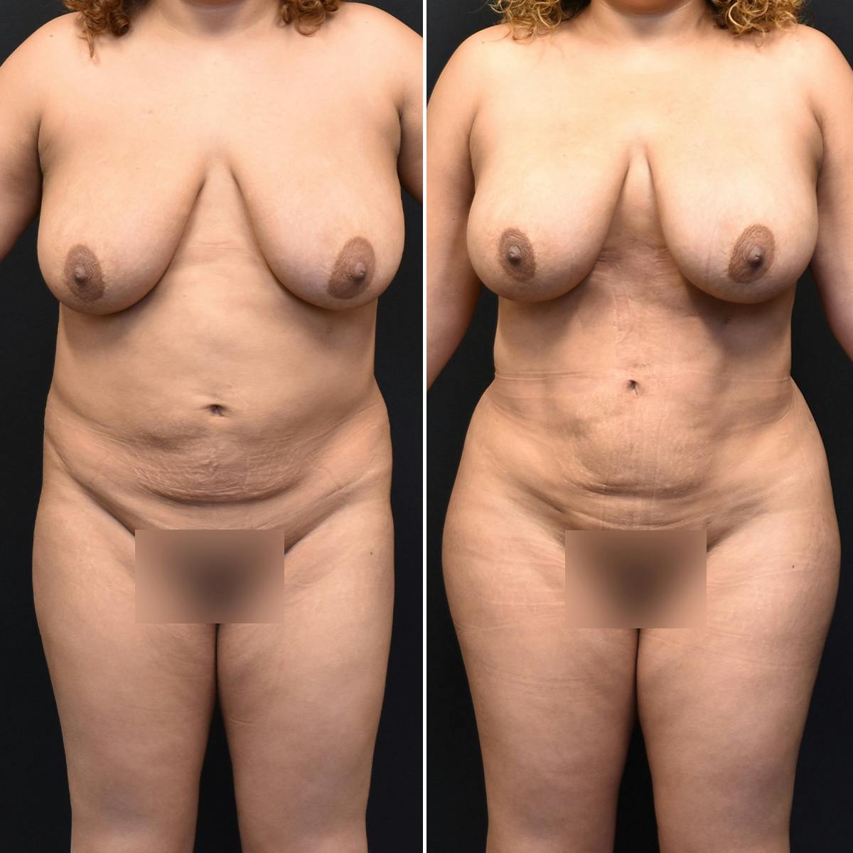 Liposuction Before & After Gallery - Patient 103465 - Image 1